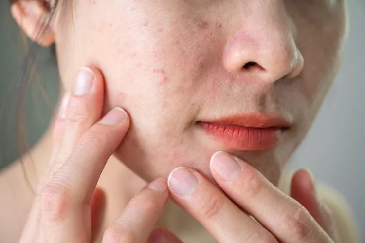 10 Best Ingredients for Acne